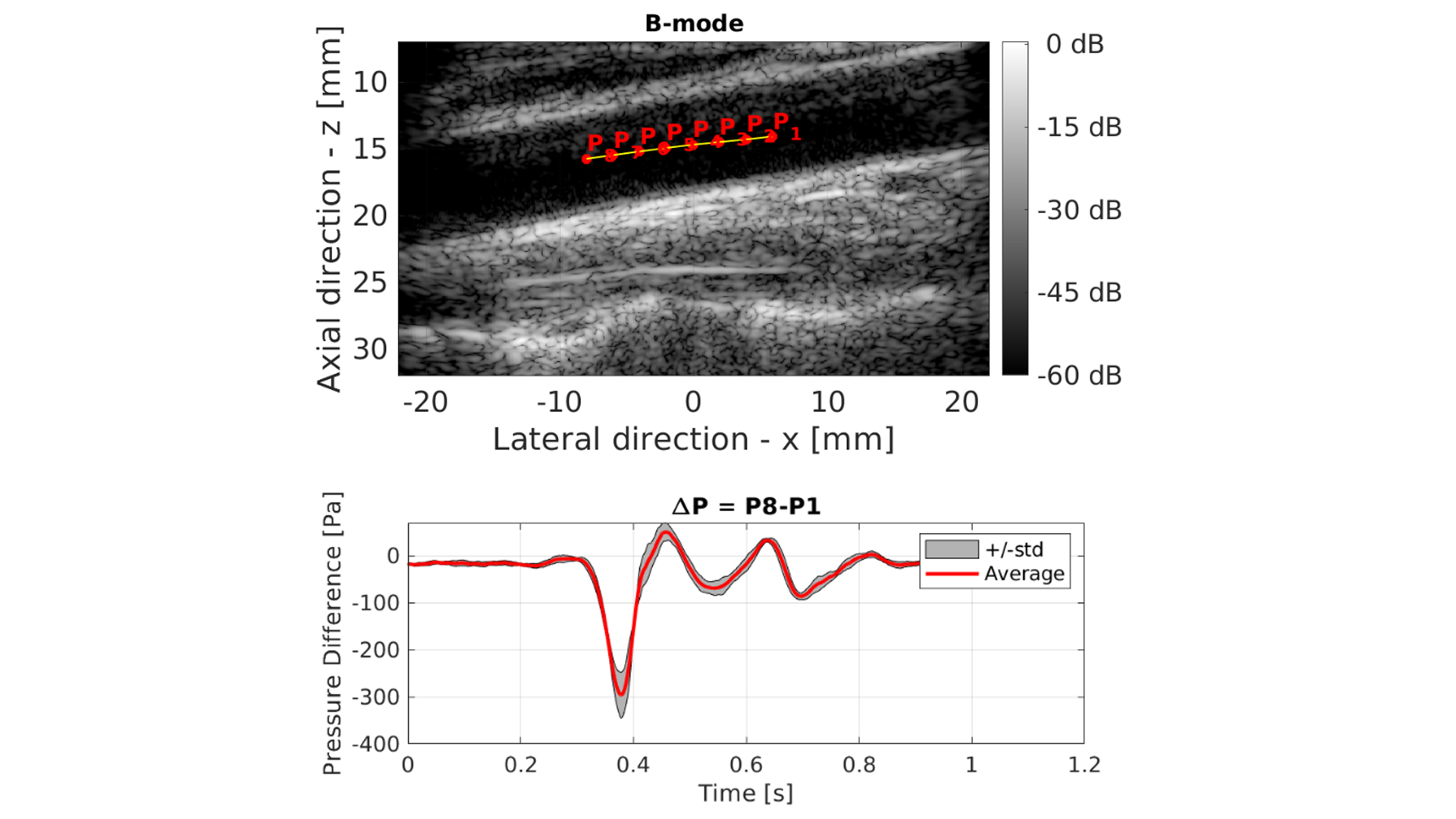 Precision of In Vivo Pressure Gradient Estimations Using Synthetic ...